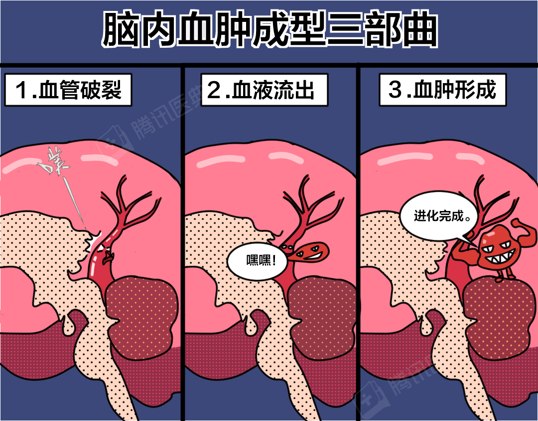脑出血是怎么引起的