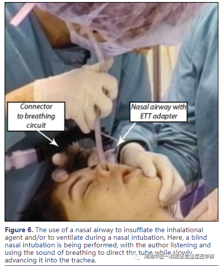 喉镜镜片怎么选困难气道的10项原则_https://www.jmylbn.com_新闻资讯_第12张