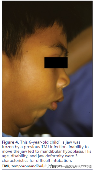 喉镜镜片怎么选困难气道的10项原则_https://www.jmylbn.com_新闻资讯_第9张