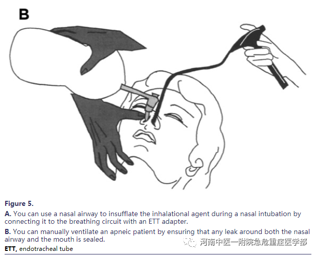 喉镜镜片怎么选困难气道的10项原则_https://www.jmylbn.com_新闻资讯_第11张