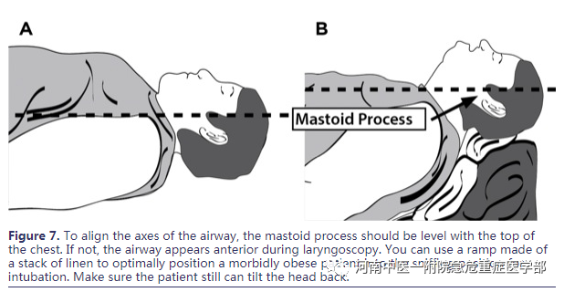 喉镜镜片怎么选困难气道的10项原则_https://www.jmylbn.com_新闻资讯_第15张