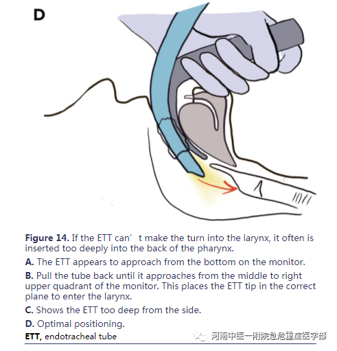 喉镜镜片怎么选困难气道的10项原则_https://www.jmylbn.com_新闻资讯_第24张
