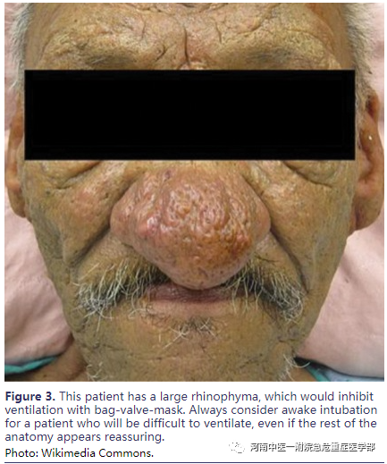 喉镜镜片怎么选困难气道的10项原则_https://www.jmylbn.com_新闻资讯_第8张