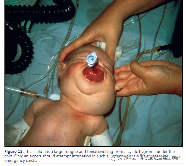 喉镜镜片怎么选困难气道的10项原则_https://www.jmylbn.com_新闻资讯_第20张