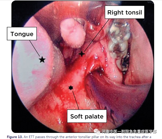 喉镜镜片怎么选困难气道的10项原则_https://www.jmylbn.com_新闻资讯_第21张