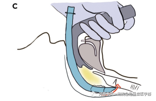 喉镜镜片怎么选困难气道的10项原则_https://www.jmylbn.com_新闻资讯_第23张