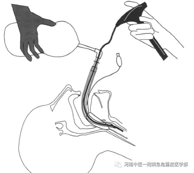 喉镜镜片怎么选困难气道的10项原则_https://www.jmylbn.com_新闻资讯_第25张