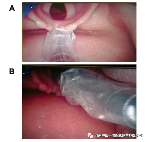 喉镜镜片怎么选困难气道的10项原则_https://www.jmylbn.com_新闻资讯_第22张