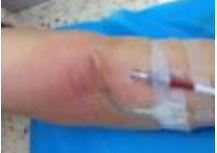 中心导管怎么使用中心静脉置管的方方面面_https://www.jmylbn.com_新闻资讯_第4张