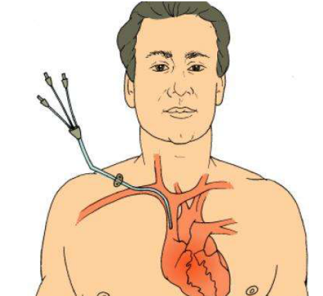中心导管怎么使用中心静脉置管的方方面面_https://www.jmylbn.com_新闻资讯_第1张