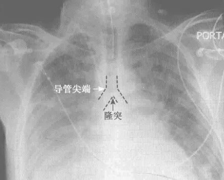 中心导管怎么使用中心静脉置管的方方面面_https://www.jmylbn.com_新闻资讯_第3张
