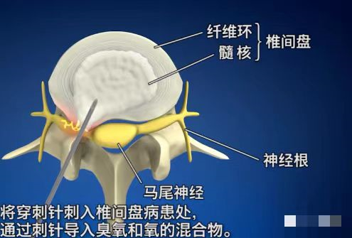 医用三氧是什么[深入解析]医用三氧治疗腰椎间盘突出症_https://www.jmylbn.com_新闻资讯_第25张