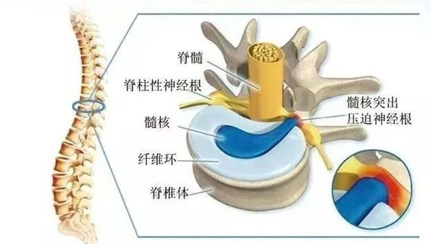 医用三氧是什么[深入解析]医用三氧治疗腰椎间盘突出症_https://www.jmylbn.com_新闻资讯_第4张