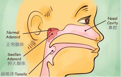 孩子睡觉打鼾，是因为腺样体肥大吗？