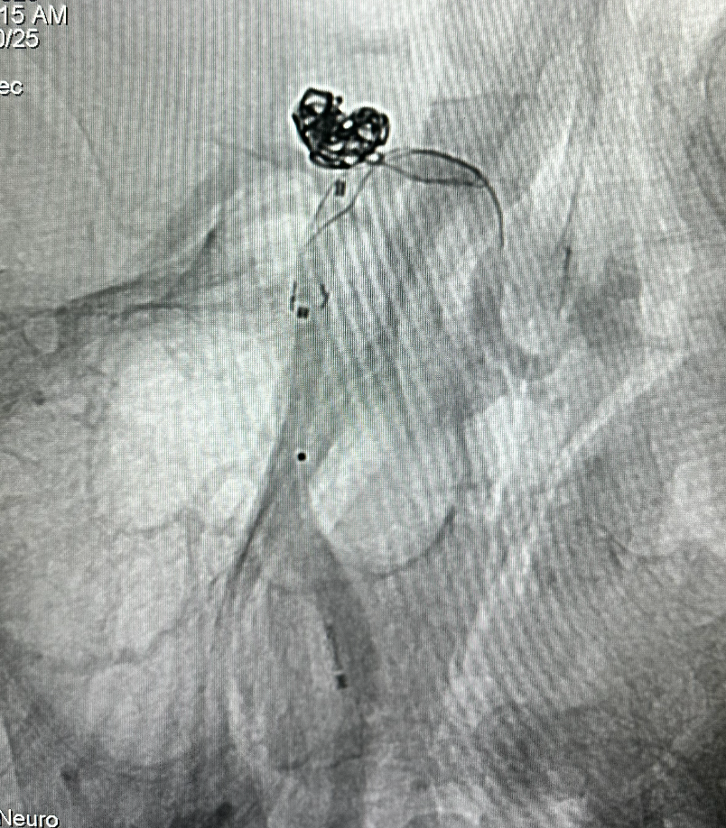 什么达医畅疗·第五期 ｜ 畅医达17小系统动脉瘤辅助支架治疗基底动脉尖不规则宽颈动脉瘤_https://www.jmylbn.com_新闻资讯_第25张