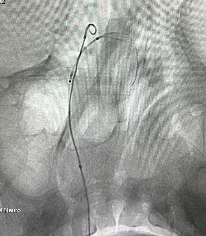 什么达医畅疗·第五期 ｜ 畅医达17小系统动脉瘤辅助支架治疗基底动脉尖不规则宽颈动脉瘤_https://www.jmylbn.com_新闻资讯_第19张