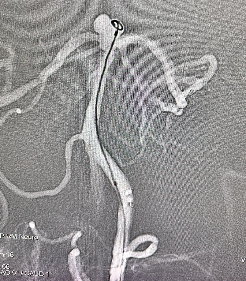 什么达医畅疗·第五期 ｜ 畅医达17小系统动脉瘤辅助支架治疗基底动脉尖不规则宽颈动脉瘤_https://www.jmylbn.com_新闻资讯_第18张