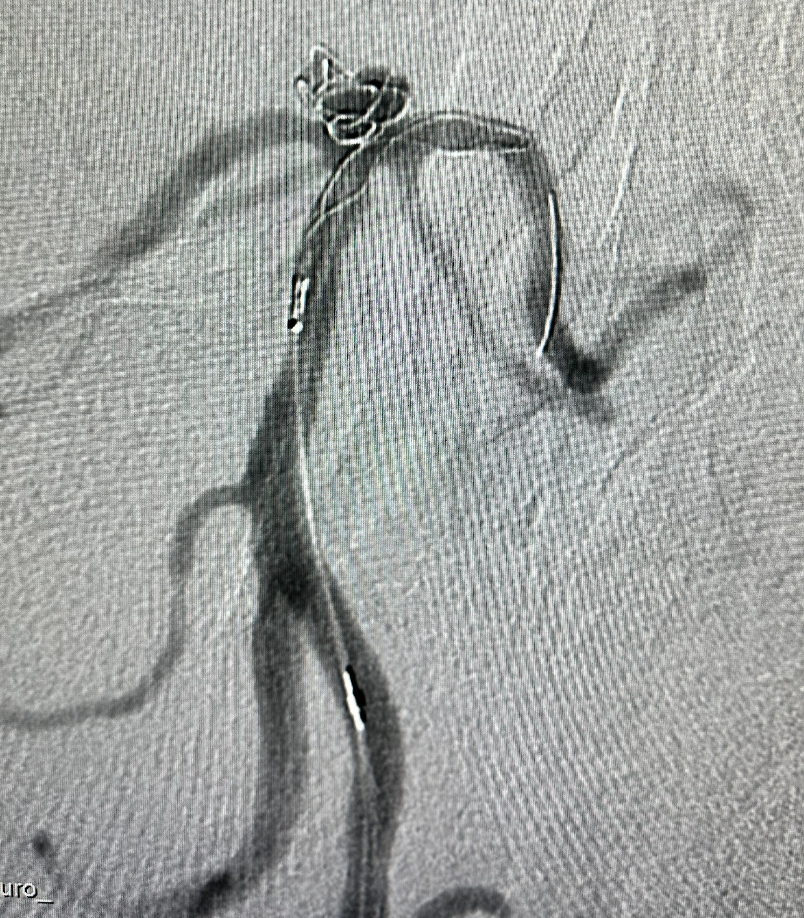 什么达医畅疗·第五期 ｜ 畅医达17小系统动脉瘤辅助支架治疗基底动脉尖不规则宽颈动脉瘤_https://www.jmylbn.com_新闻资讯_第22张