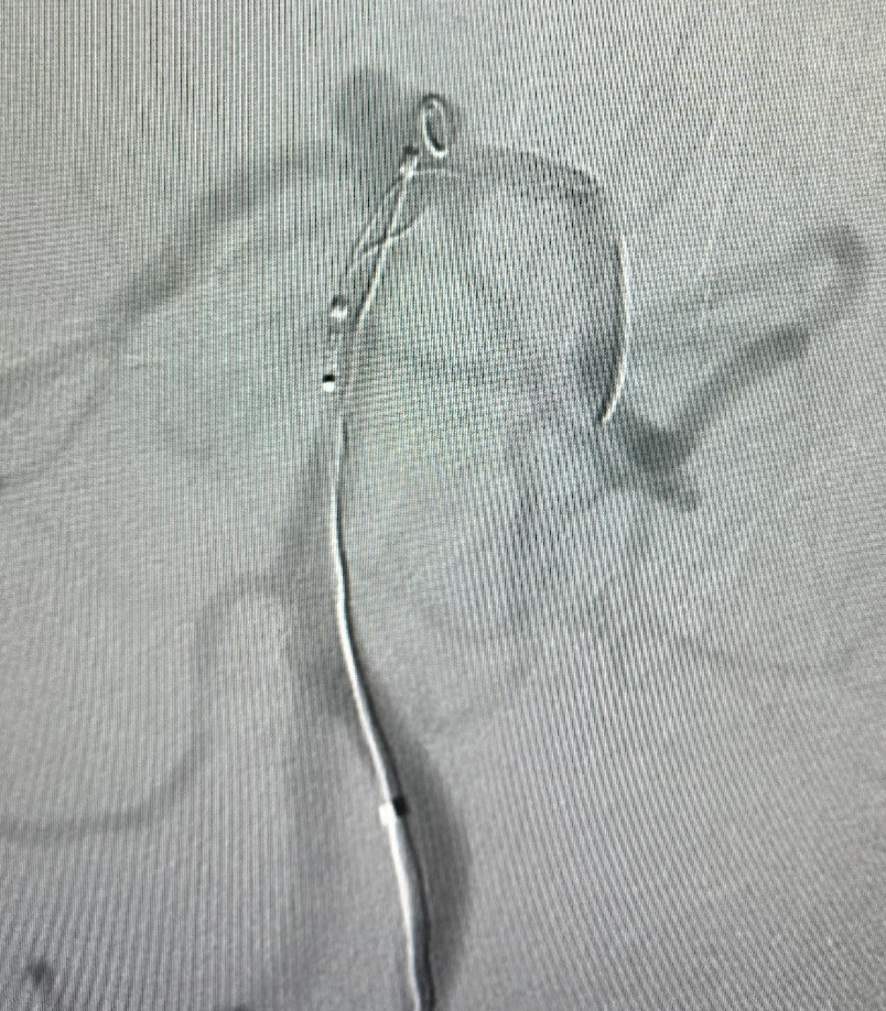 什么达医畅疗·第五期 ｜ 畅医达17小系统动脉瘤辅助支架治疗基底动脉尖不规则宽颈动脉瘤_https://www.jmylbn.com_新闻资讯_第21张