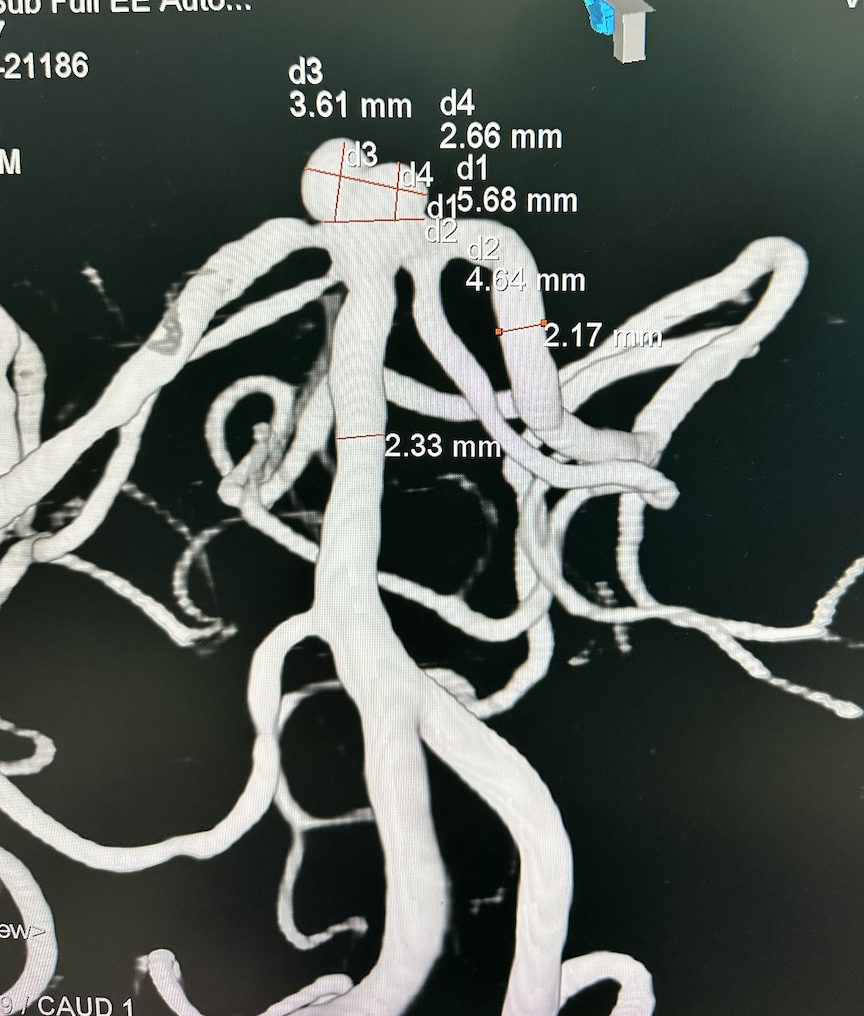 什么达医畅疗·第五期 ｜ 畅医达17小系统动脉瘤辅助支架治疗基底动脉尖不规则宽颈动脉瘤_https://www.jmylbn.com_新闻资讯_第8张