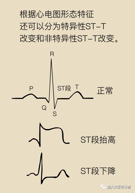 心电图stt改变一定是心脏供血不足吗