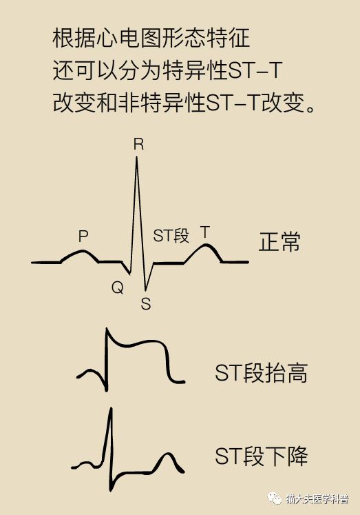 ST-T改变是什么原因？