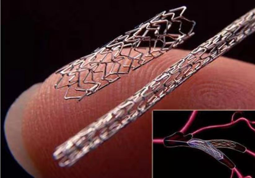 什么是外周支架【世界心脏日】心脏支架植入，八大“灵魂拷问”_https://www.jmylbn.com_新闻资讯_第6张