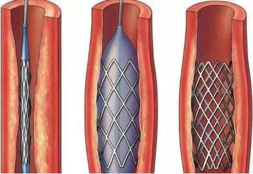 什么是外周支架【世界心脏日】心脏支架植入，八大“灵魂拷问”_https://www.jmylbn.com_新闻资讯_第5张