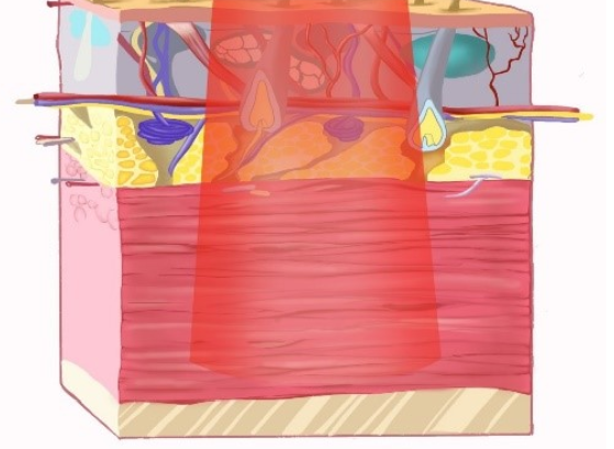 微波怎么治疗高频电疗法——微波疗法_https://www.jmylbn.com_新闻资讯_第3张