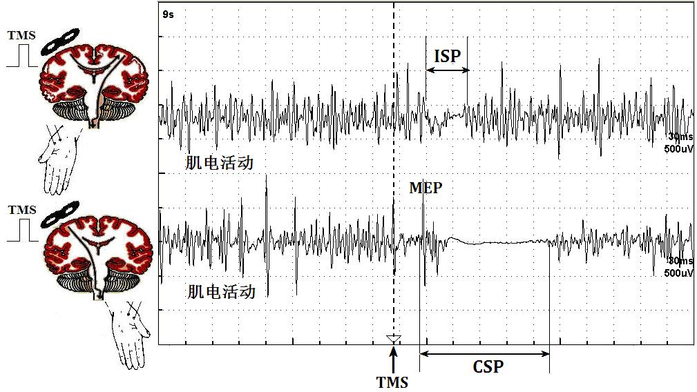 tms什么医疗经颅磁刺激—治疗之外的价值_https://www.jmylbn.com_新闻资讯_第18张
