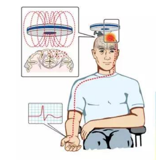 tms什么医疗经颅磁刺激—治疗之外的价值_https://www.jmylbn.com_新闻资讯_第12张