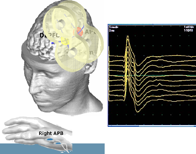 tms什么医疗经颅磁刺激—治疗之外的价值_https://www.jmylbn.com_新闻资讯_第13张