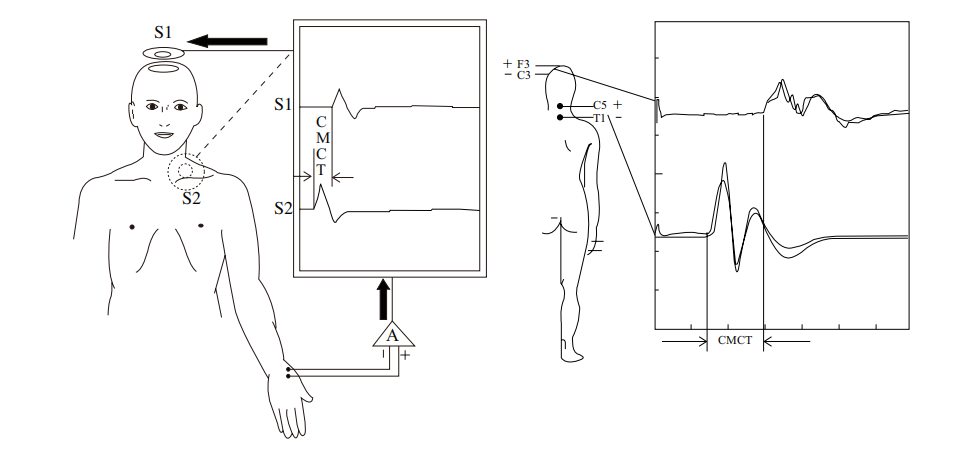 tms什么医疗经颅磁刺激—治疗之外的价值_https://www.jmylbn.com_新闻资讯_第16张