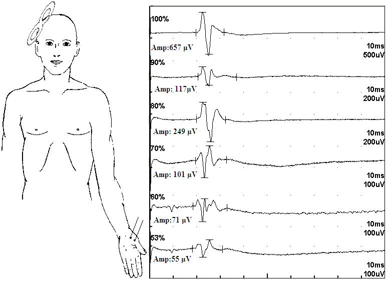 tms什么医疗经颅磁刺激—治疗之外的价值_https://www.jmylbn.com_新闻资讯_第15张