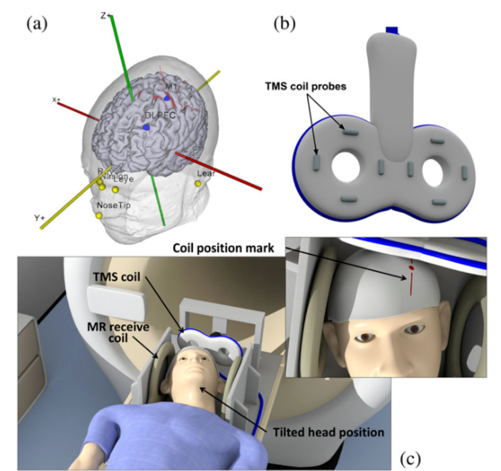 tms什么医疗经颅磁刺激—治疗之外的价值_https://www.jmylbn.com_新闻资讯_第23张