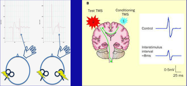 tms什么医疗经颅磁刺激—治疗之外的价值_https://www.jmylbn.com_新闻资讯_第21张