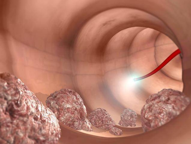 电子直肠镜怎么做做结直肠镜检查前，要做好哪些准备？_https://www.jmylbn.com_新闻资讯_第13张