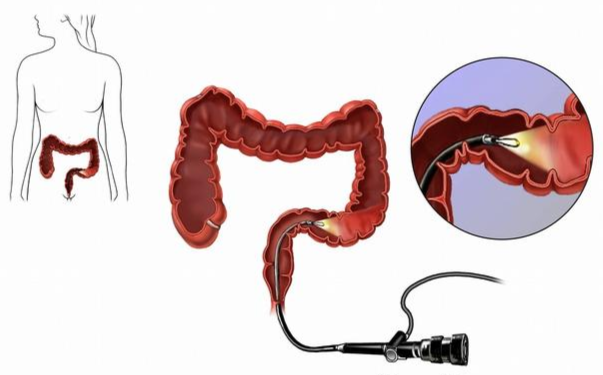 电子直肠镜怎么做做结直肠镜检查前，要做好哪些准备？_https://www.jmylbn.com_新闻资讯_第10张