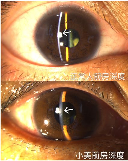 入院眼压高达43mmhg(正常眼压参考10～21mmhg),裂隙灯与ubm检查均已