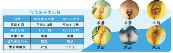 痔疮套扎吻合器怎么用【健康百科】市四院带您了解自动弹力线痔套扎术（RPH）_https://www.jmylbn.com_新闻资讯_第1张
