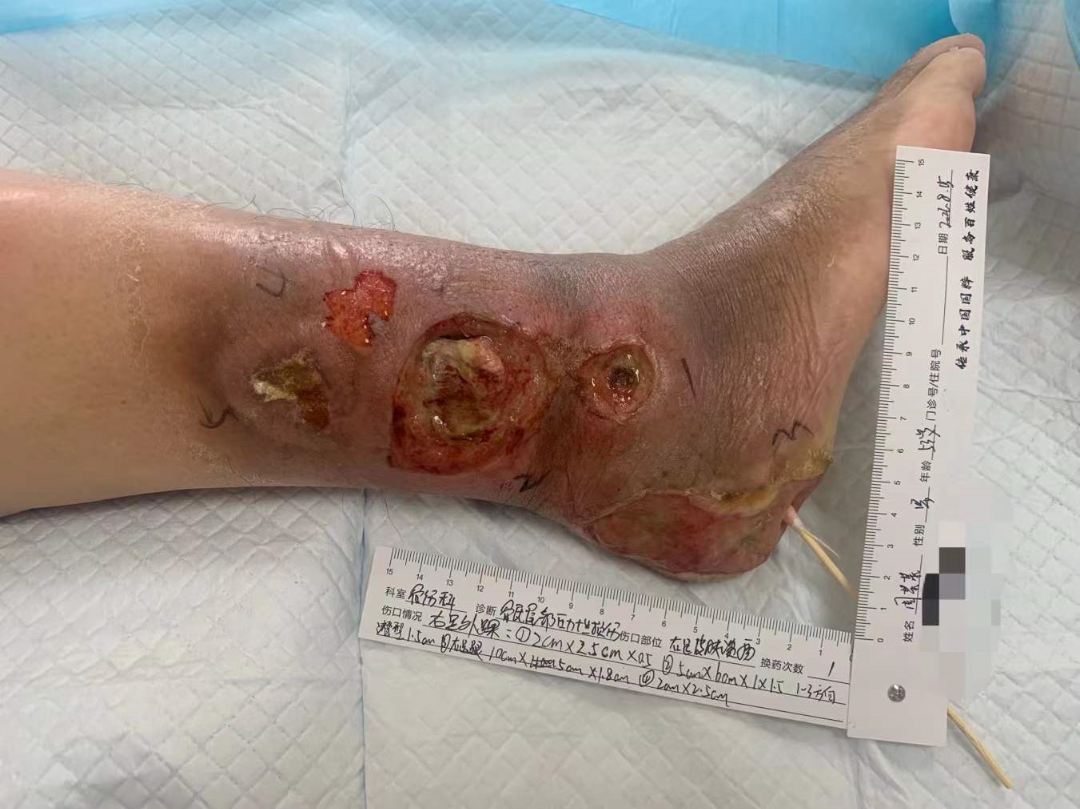 伤口负压治疗怎么收费慢创伤口患者的福音｜ 县民族中医院负压治疗技术运用成熟_https://www.jmylbn.com_新闻资讯_第4张