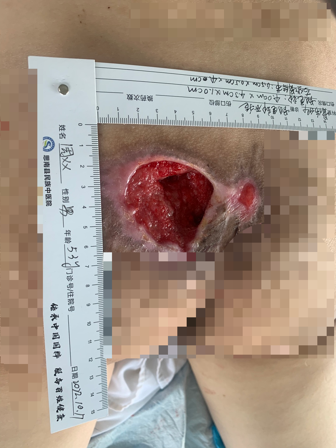 伤口负压治疗怎么收费慢创伤口患者的福音｜ 县民族中医院负压治疗技术运用成熟_https://www.jmylbn.com_新闻资讯_第10张