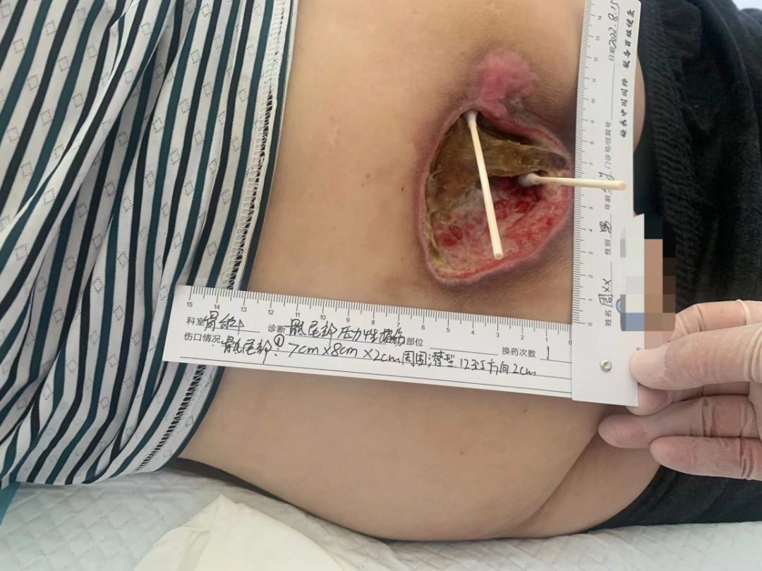 伤口负压治疗怎么收费慢创伤口患者的福音｜ 县民族中医院负压治疗技术运用成熟_https://www.jmylbn.com_新闻资讯_第3张