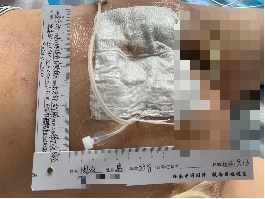 伤口负压治疗怎么收费慢创伤口患者的福音｜ 县民族中医院负压治疗技术运用成熟_https://www.jmylbn.com_新闻资讯_第7张