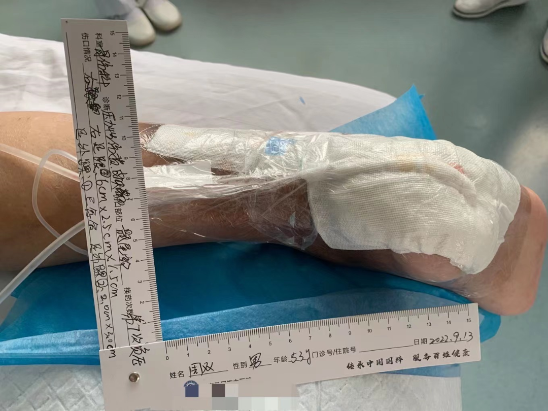 伤口负压治疗怎么收费慢创伤口患者的福音｜ 县民族中医院负压治疗技术运用成熟_https://www.jmylbn.com_新闻资讯_第8张