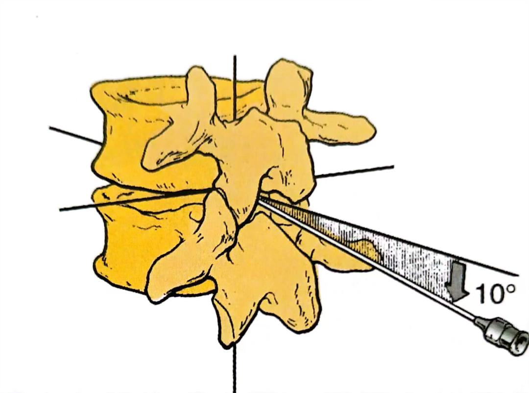 怎么知道穿刺到硬膜外详解正中入路硬膜外穿刺操作步骤_https://www.jmylbn.com_新闻资讯_第2张