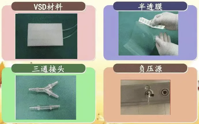 vsd引流怎么拔出【科室风采】创面的吸引器——VSD负压引流技术_https://www.jmylbn.com_新闻资讯_第4张