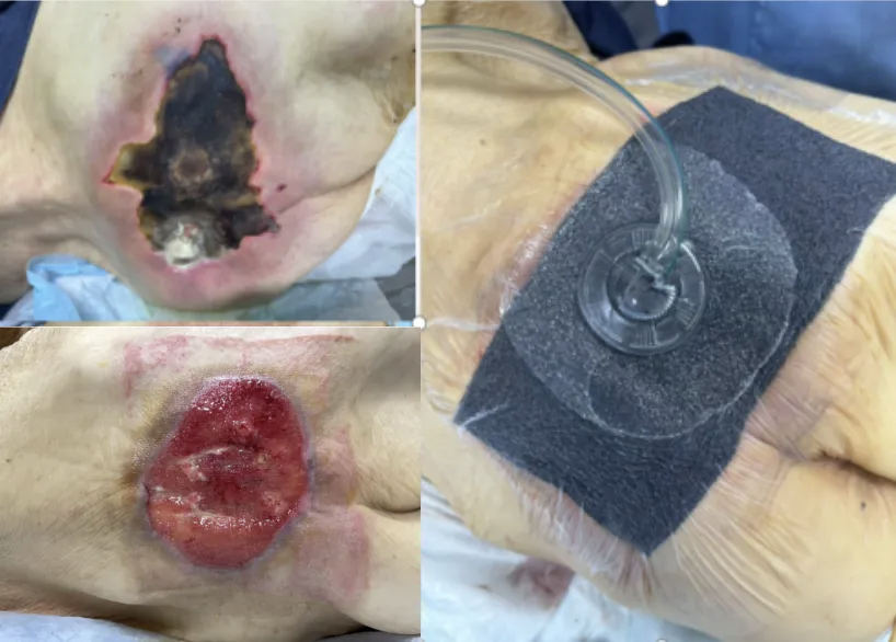 vsd引流怎么拔出【科室风采】创面的吸引器——VSD负压引流技术_https://www.jmylbn.com_新闻资讯_第3张