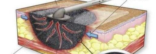 vsd引流怎么拔出【科室风采】创面的吸引器——VSD负压引流技术_https://www.jmylbn.com_新闻资讯_第5张