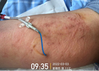 什么是医用导管固定贴PICC 局部发红发痒：是贴膜过敏，还是接触性皮炎？一文理清！_https://www.jmylbn.com_新闻资讯_第11张